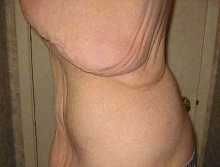 某400斤男子减肥后 某400斤男子减肥后