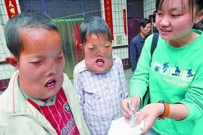 怪胎婴儿_怪胎婴儿似青蛙图片